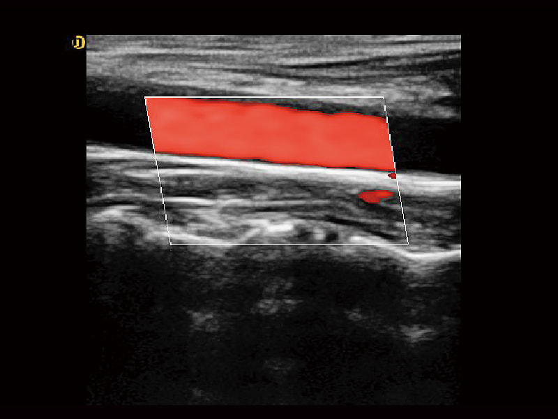 Tissue Harmonic Imaging (THI)