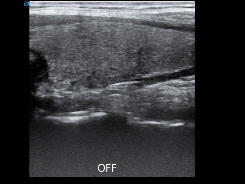 speckle reduction imaging off