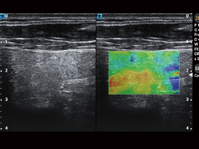 Elastography