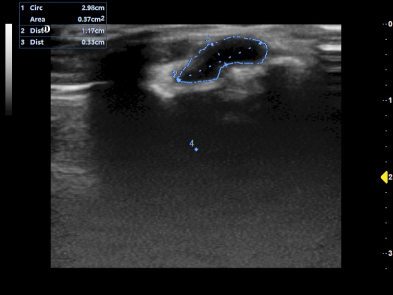 MSK, with Cyst