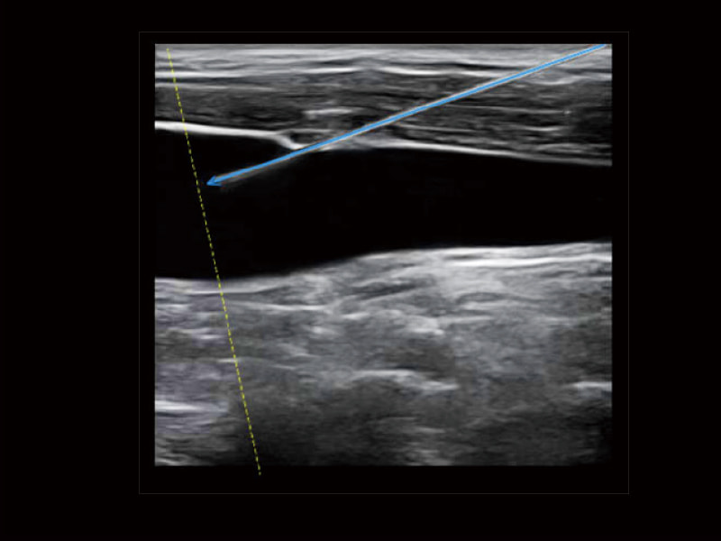 Puncture Enhancement