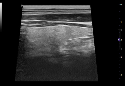 Thyroid