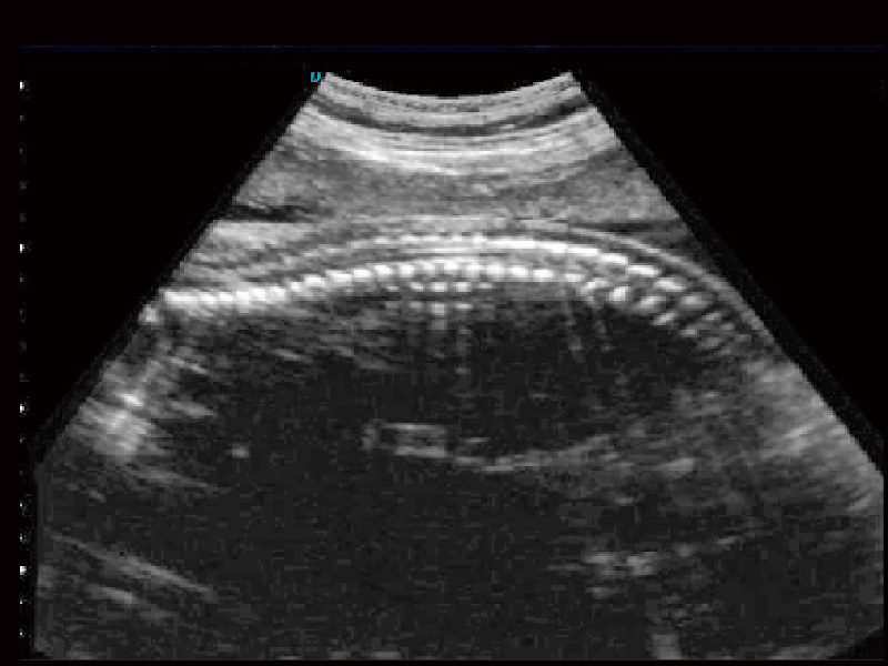 Fetal Spine Examination