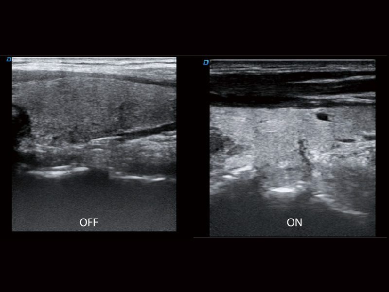 Speckle noise suppression technique