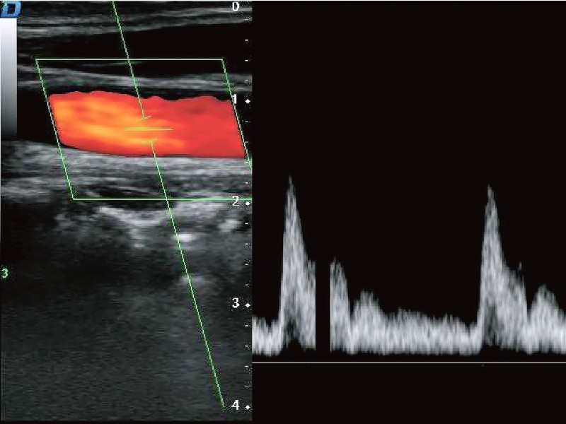 Pulsed Wave (PW)