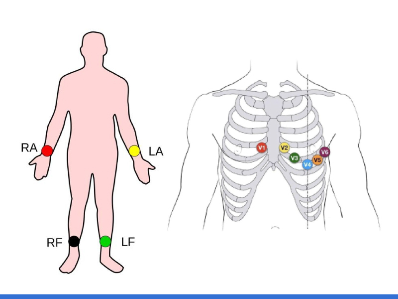 ECG Electrode Placement Key Components