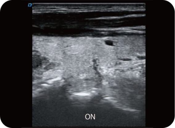Speckle Reduction Imaging (SRI)