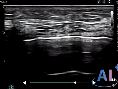 Automatic Muscle and Fat Recognition 