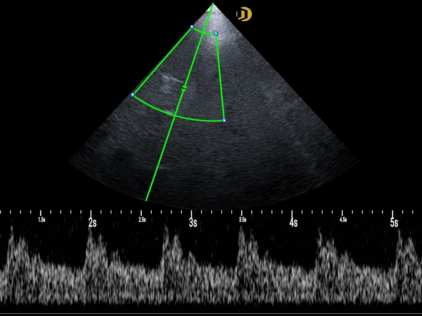 Phased-array, Transcranial Doppler