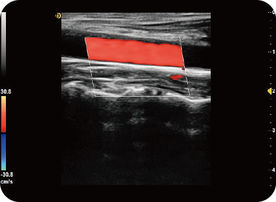 Imaging armonico tissutale (THI)