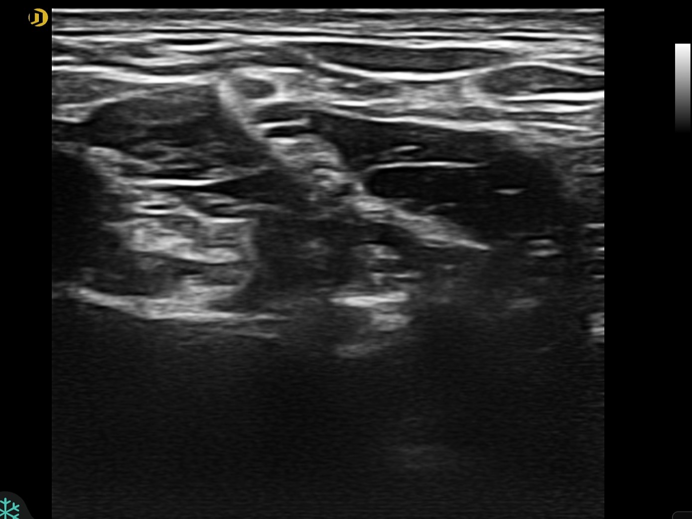 Linear Brachial plexus