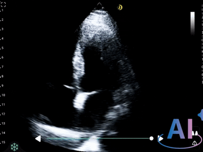Automatic ejection Fraction measurement
