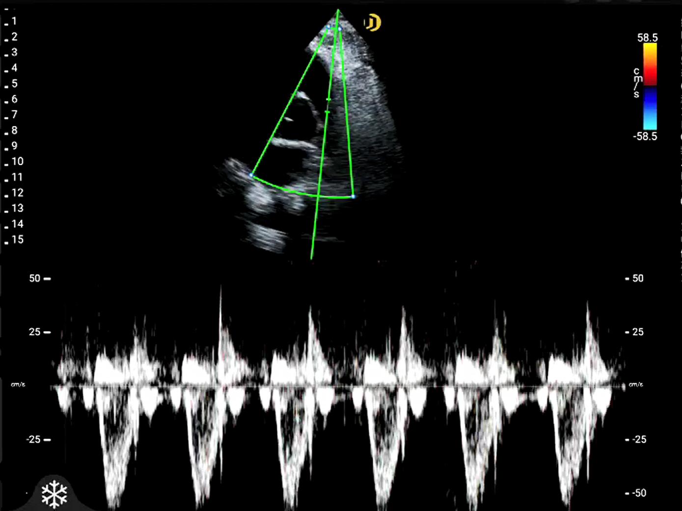 Phased-array, Cardiac, PW