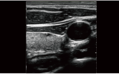Spatial compound imaging