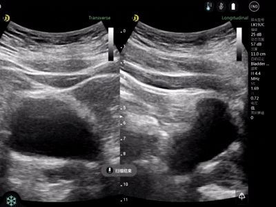 automatic bladder volumn measurement 
