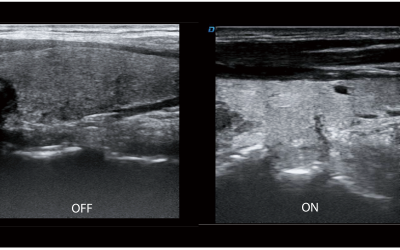 Speckle reduction imaging