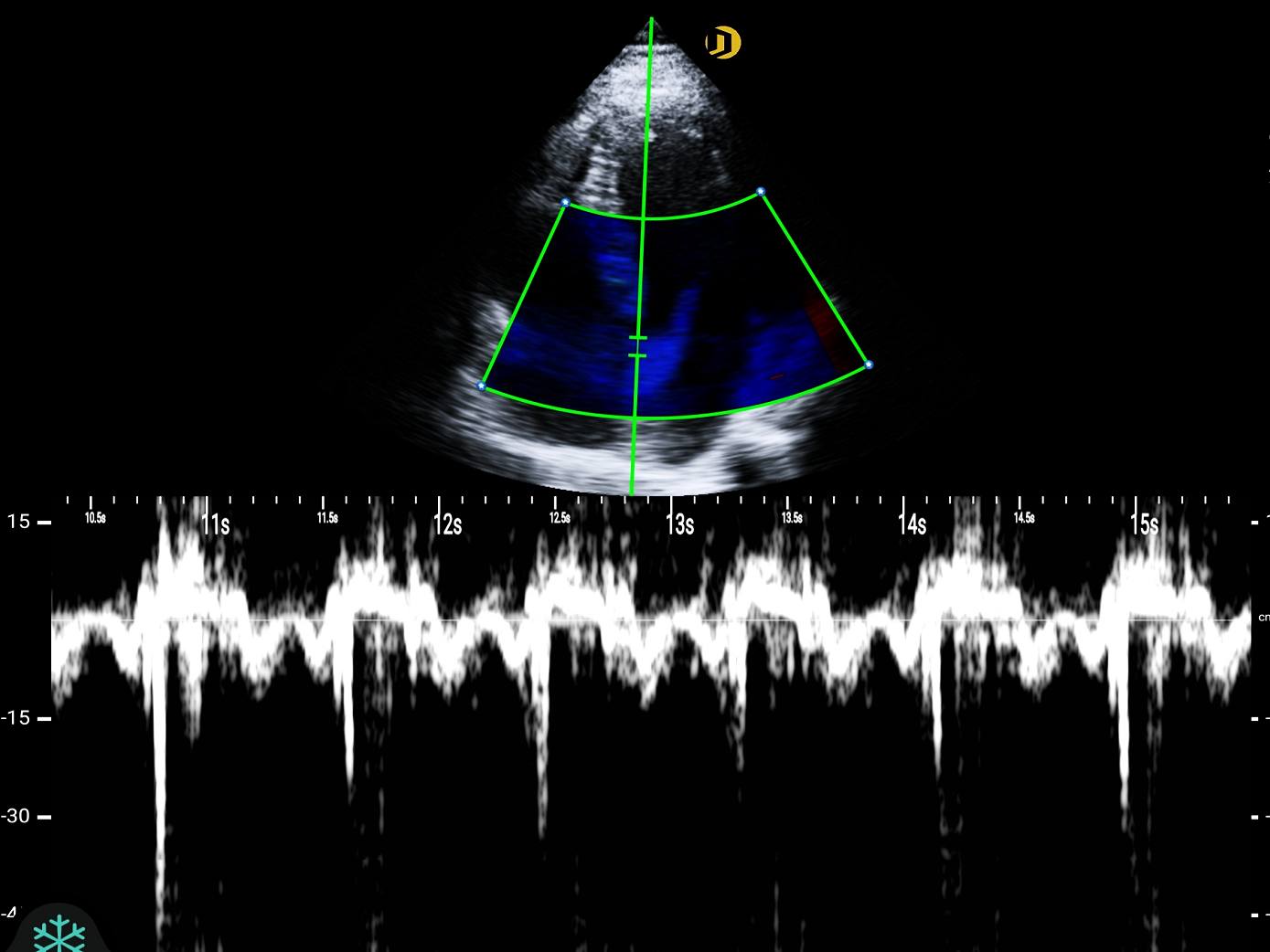 Phased-array, cardiac, TDI