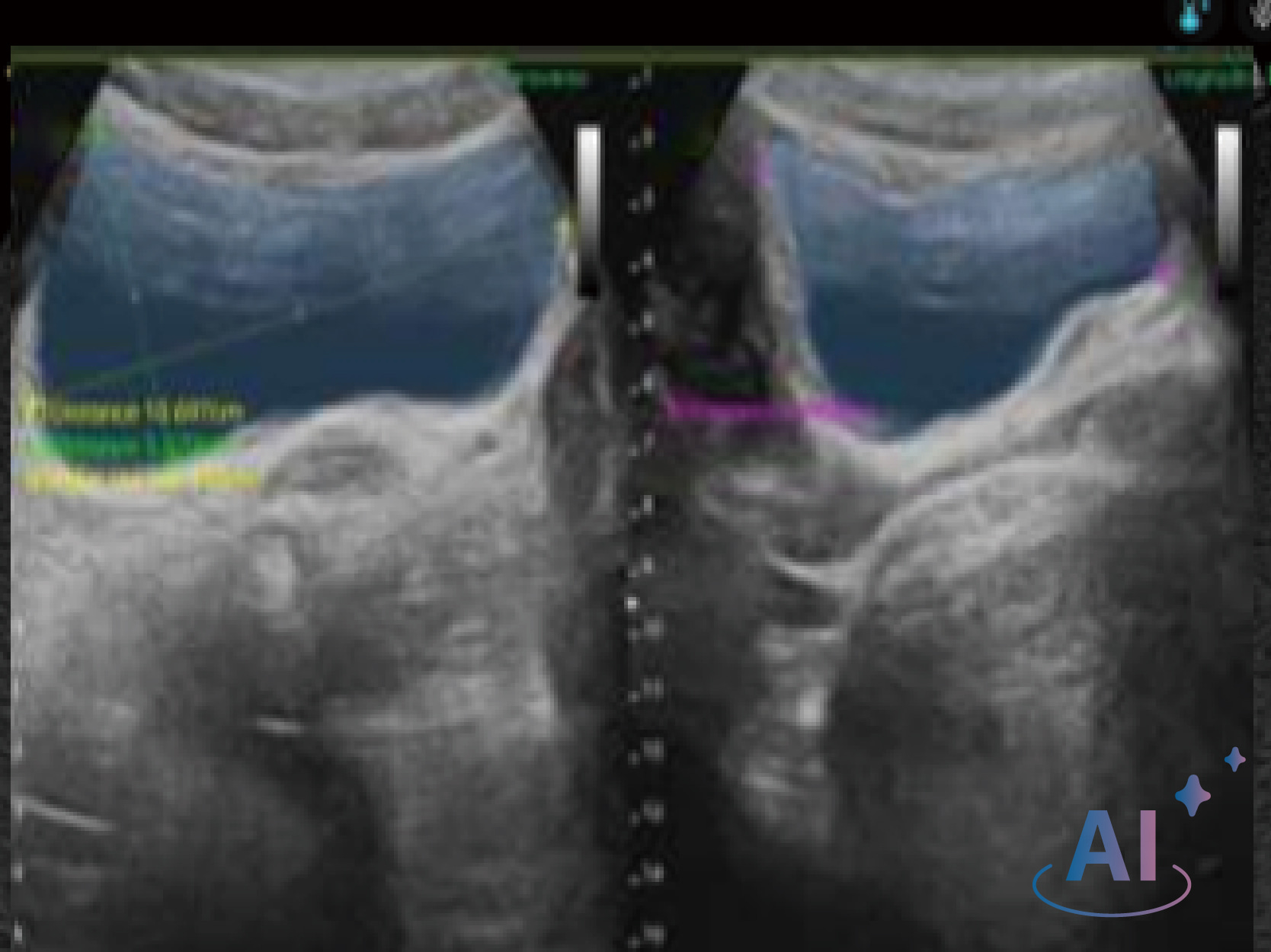 Automatic Bladder Volume Recognition