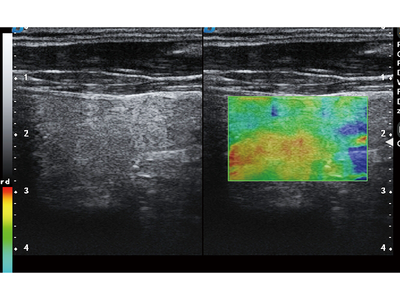 Elastography