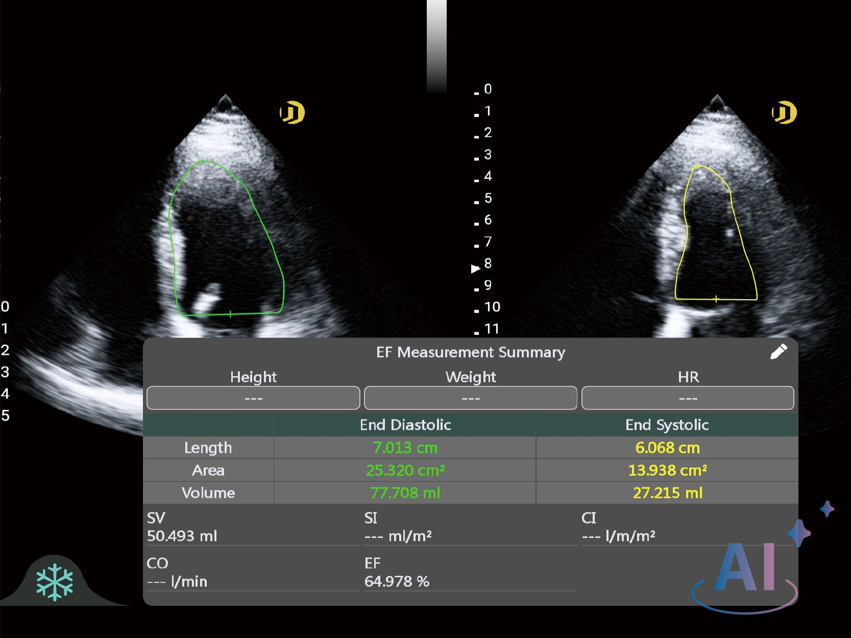 Automatic Ejection Fraction measurement
