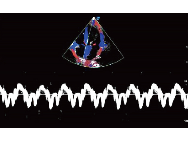 Tissue Doppler Imaging （TDI）