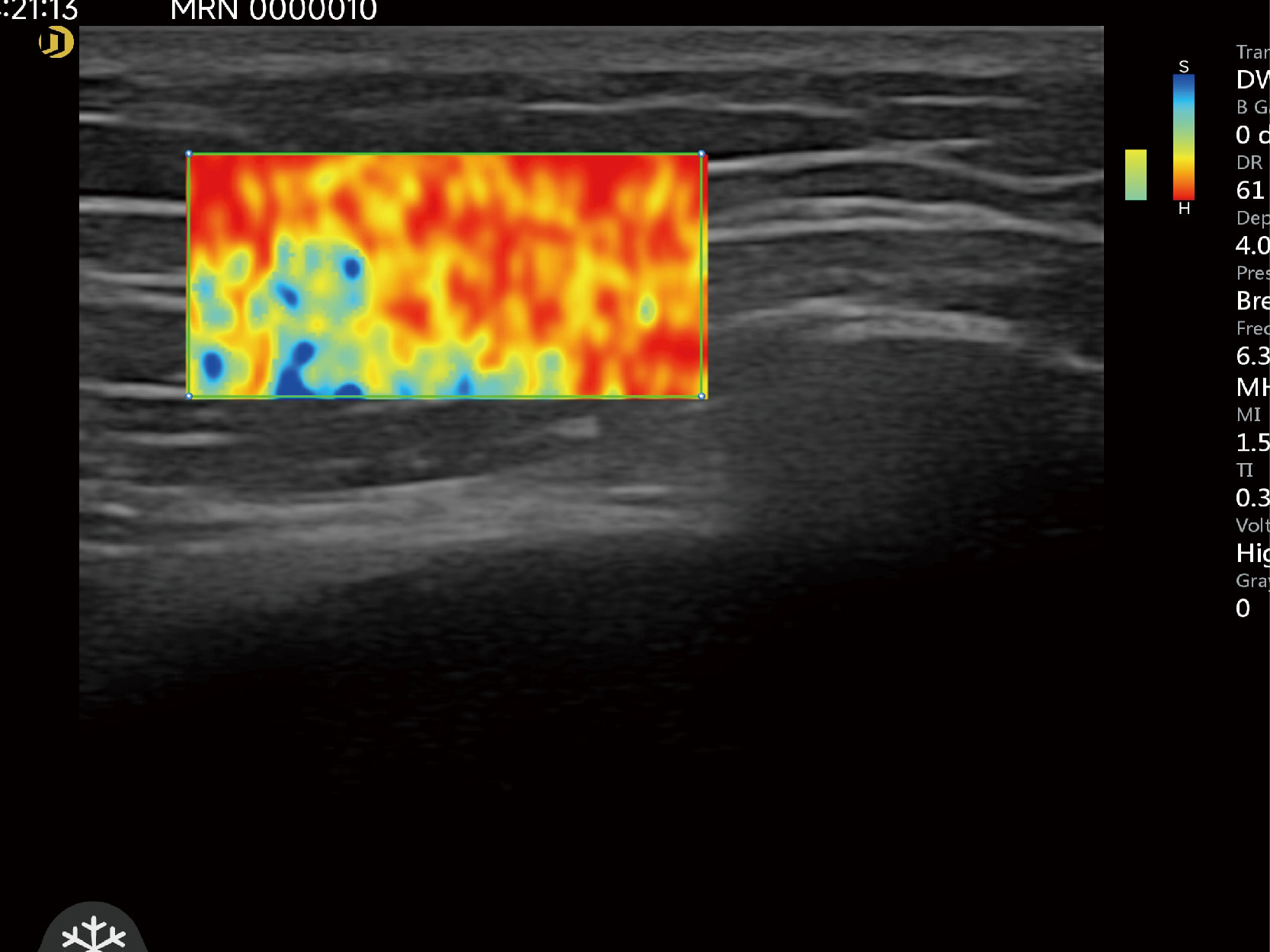 Elastography