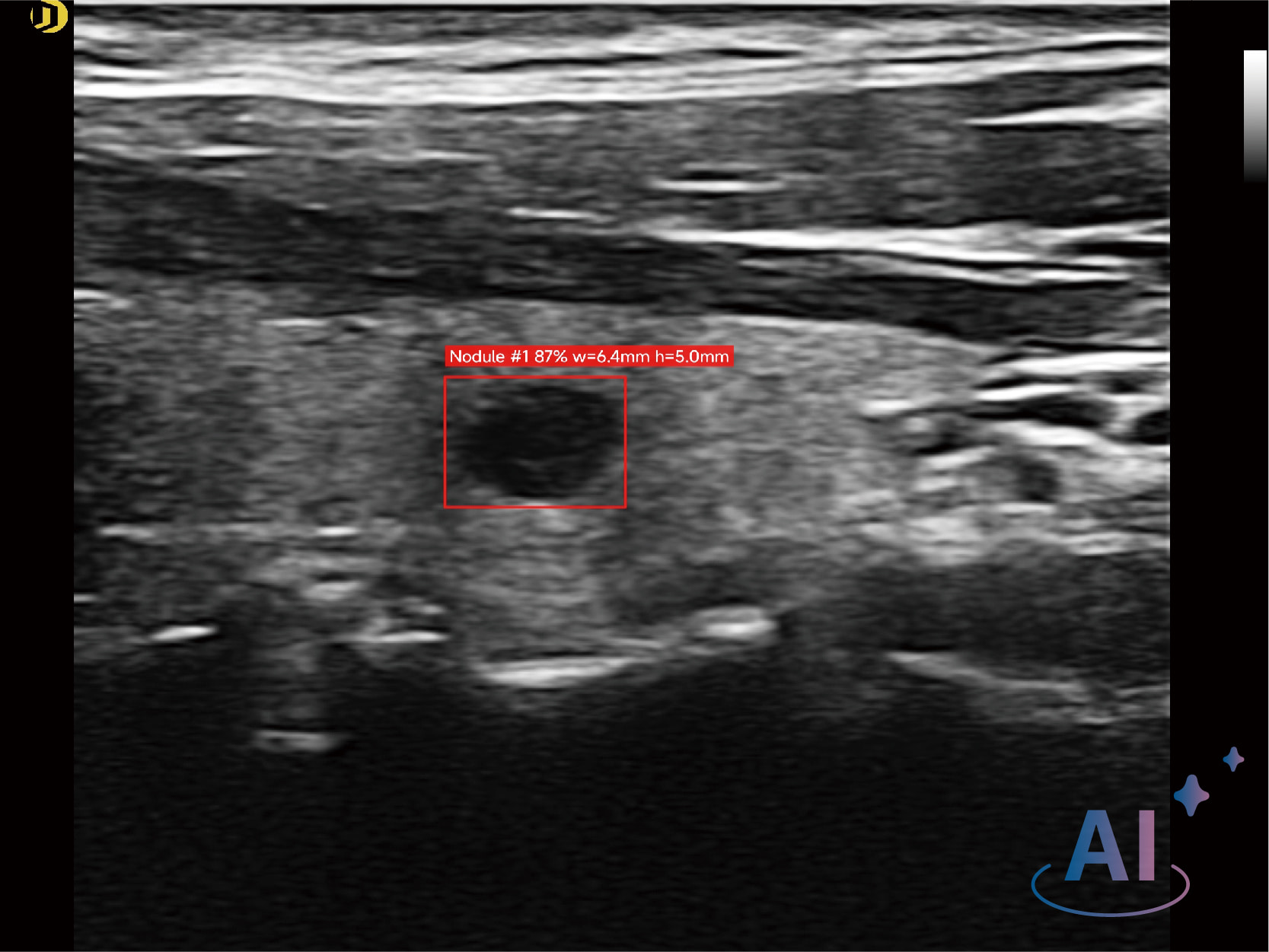 Thyroid Lesion Detection