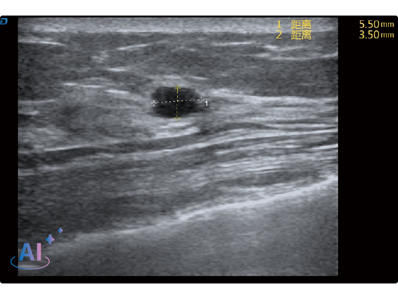 Breast Lesion Detection