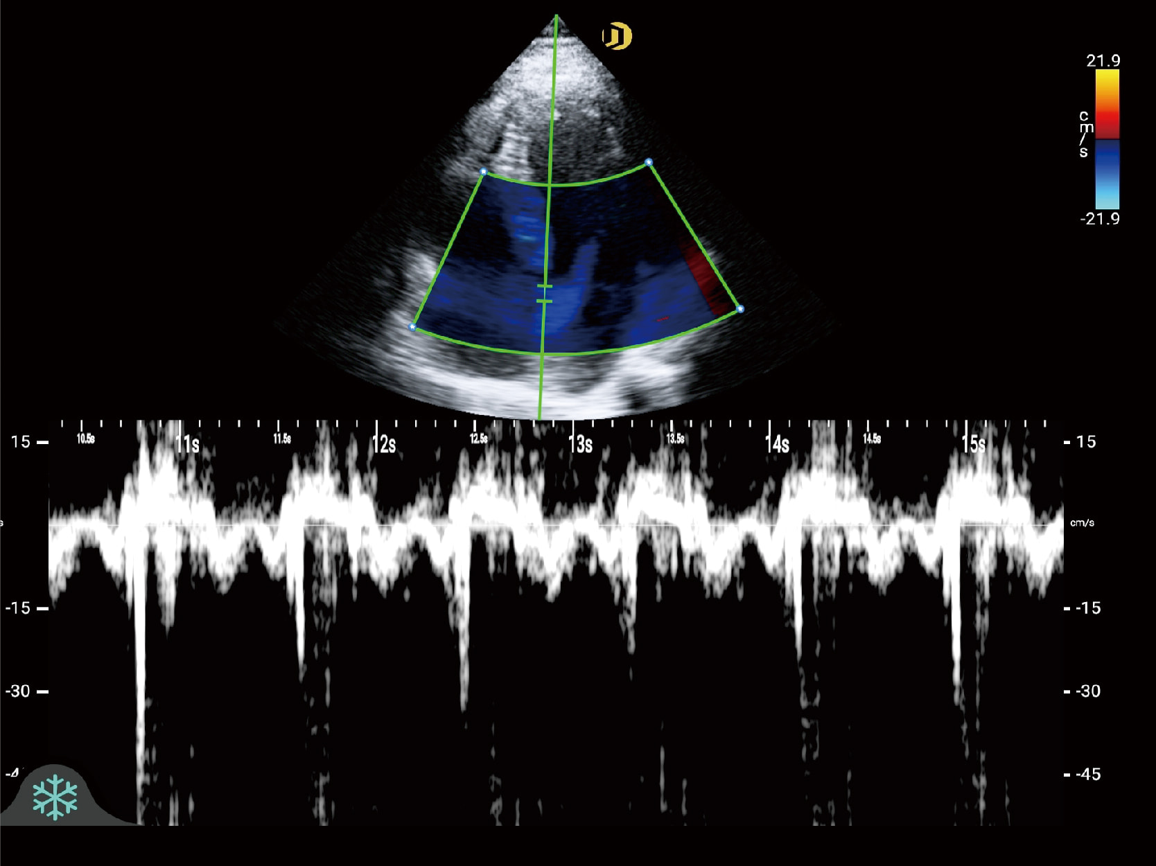 Tissue Doppler Imaging