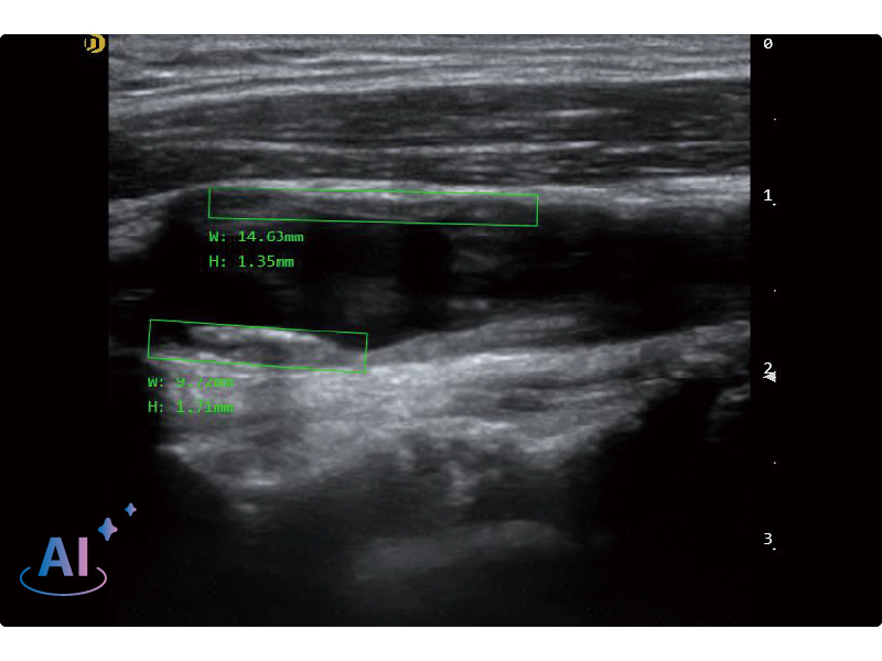 Carotid plaque detection