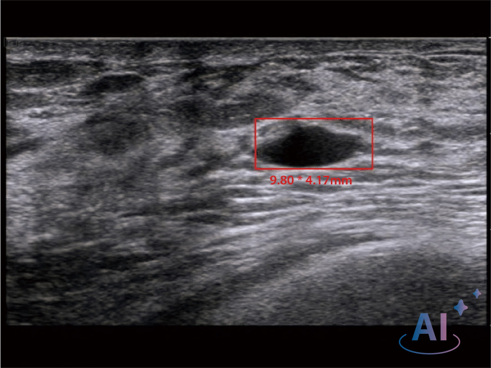 Breast Lesion Detection