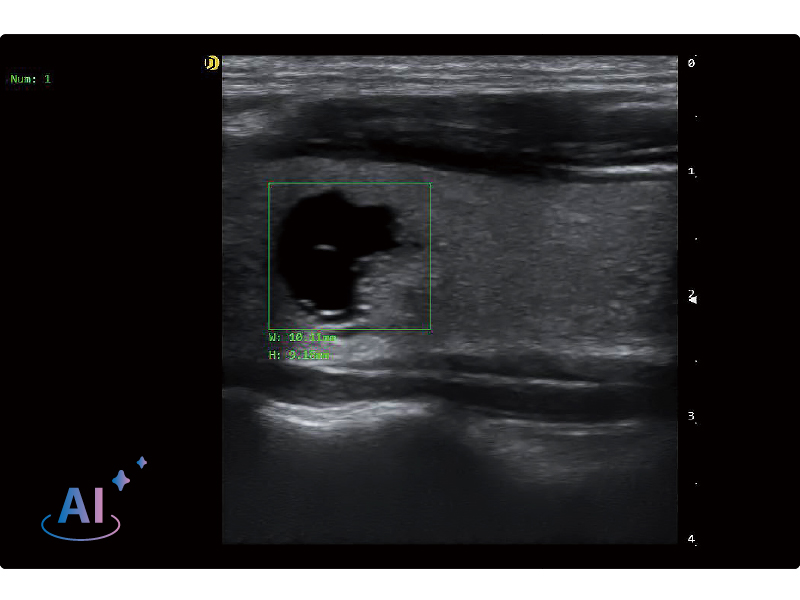 Thyroid Lesion Detection 