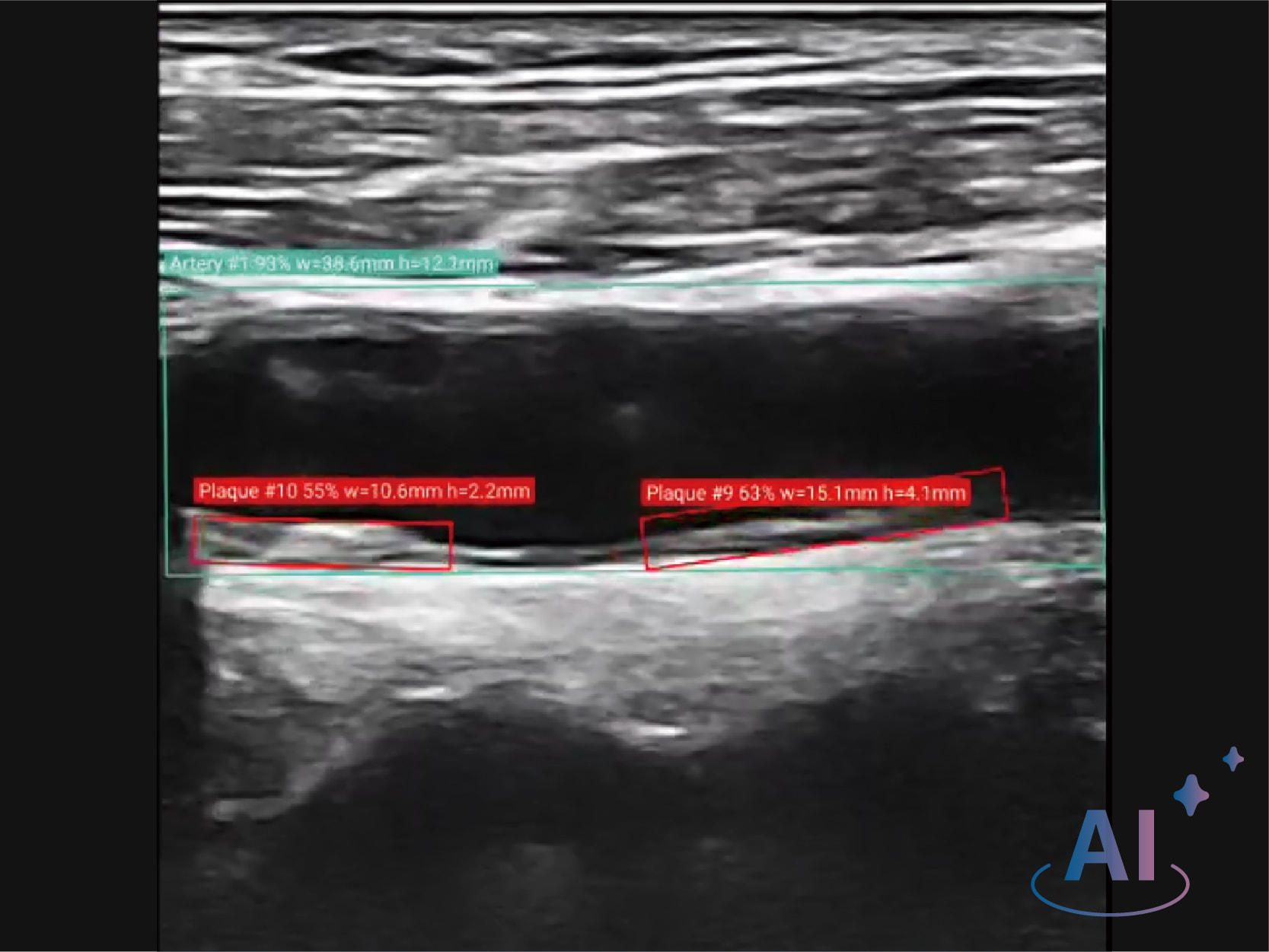 Carotid Plaque Detection