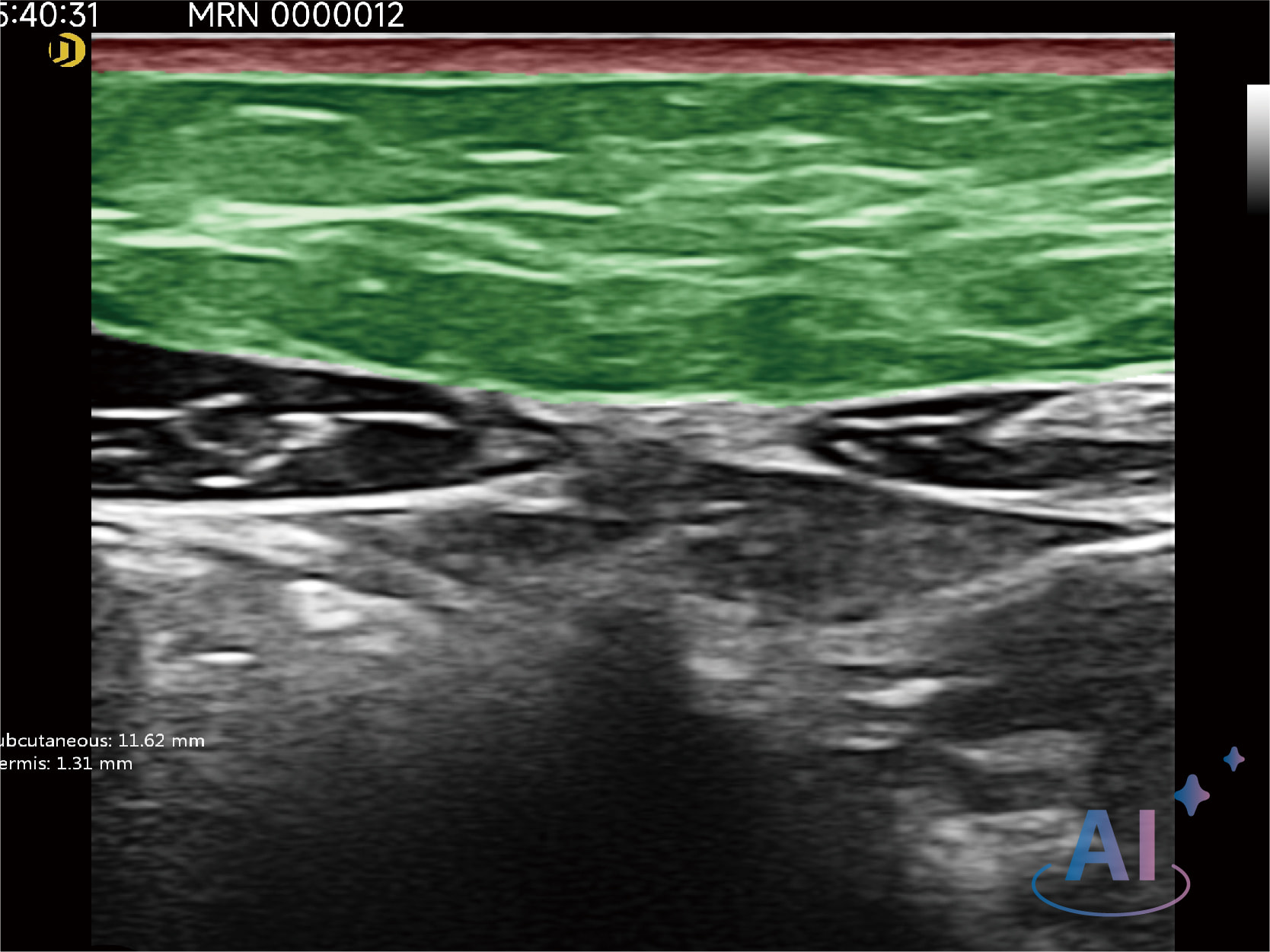 Abdominal Fat Analysis 